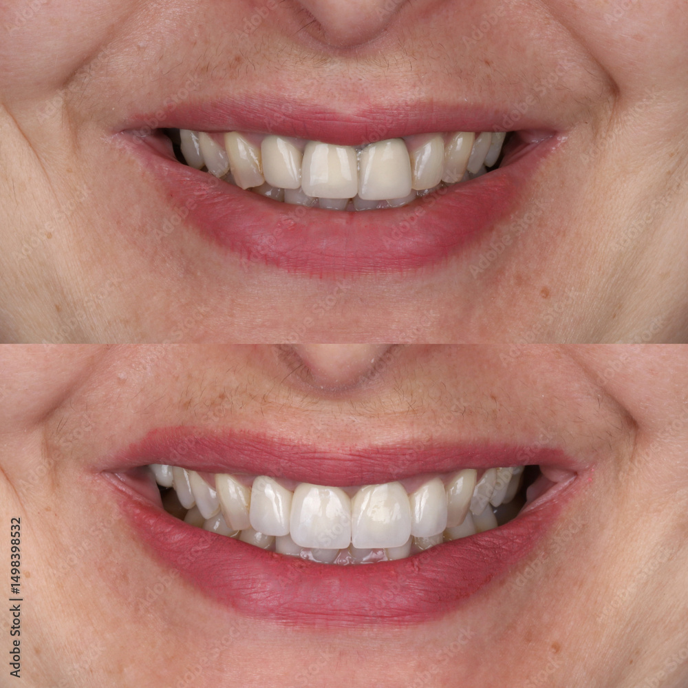 Obraz premium Dental treatment in dentistry. Smile design treatment with dental design. New tooth design with porcelain crowns. Full arch dental treatment. Dental before after and smile makeover.