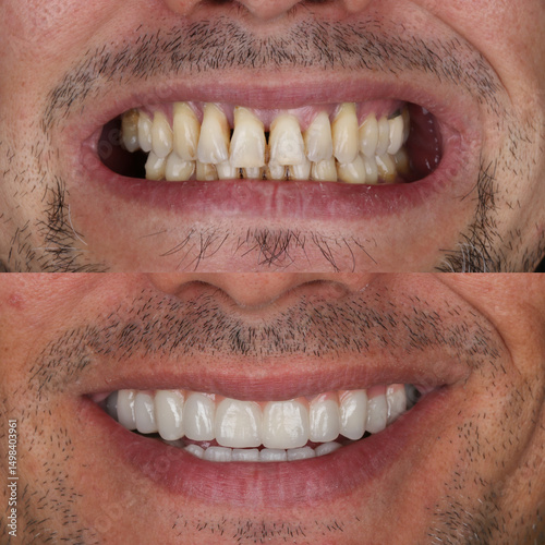 Dental implant treatment with oral surgery. Treatment of tooth loss. Porcelain dental prosthesis placed on implants embedded in the jawbone. Dental before after and smile makeover.

