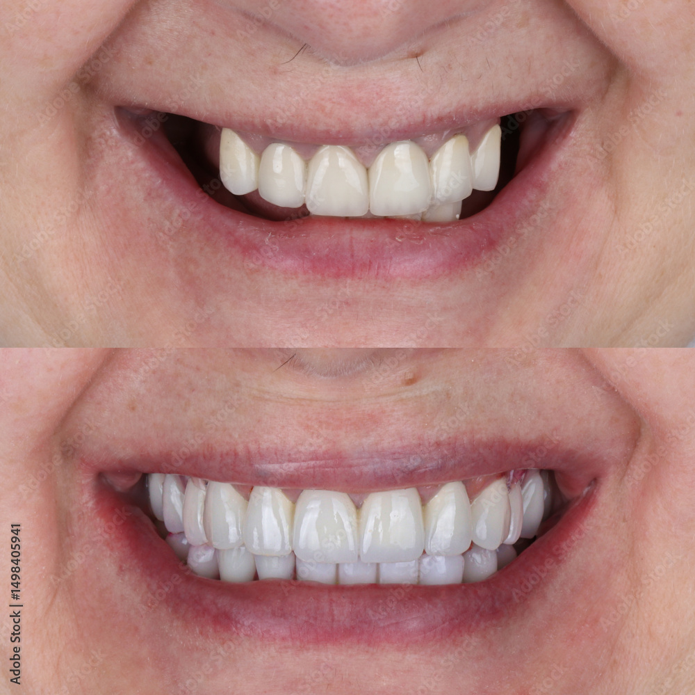 Obraz premium Treatment of all teeth in the mouth with porcelain crowns in dentistry. Smile design treatment. Smile makeover with digital dentistry. Dental before after.