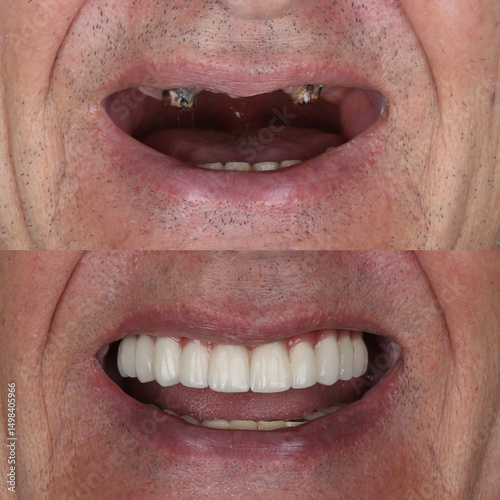 Bone level dental implants and full arch dental prosthesis in dentistry. Full mouth implant supported prosthesis for edentulous jaws. Dental before after and smile makeover.


