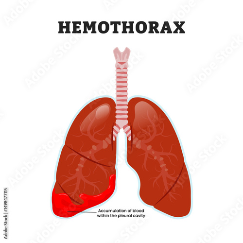 Hemothorax Lung or hemopneumothorax, educational medical poster design healthcare scheme, human lung disease internal organs. Labeled blood accumulation within pleural cavity or space