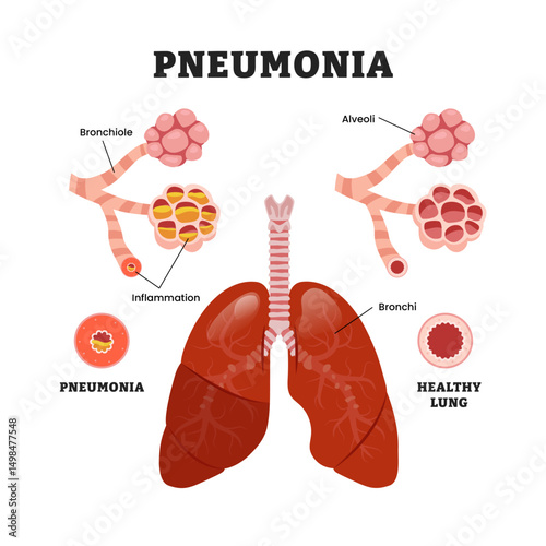 Healthy vs Pneumonia Lung difference, educational medical poster design healthcare scheme, human lung disease internal organs. Labeled inflammation bronchiole, alveoli caused by bacteria.