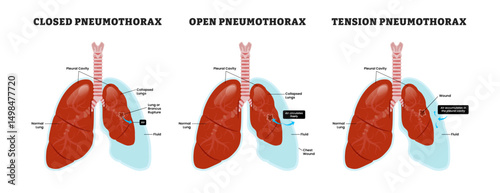 Closed, Open and Tension Pneumothorax, Lung, educational medical poster design healthcare scheme, human lung disease internal organs. Labeled collapsed lung, bronchial rupture, trapped air leaks.