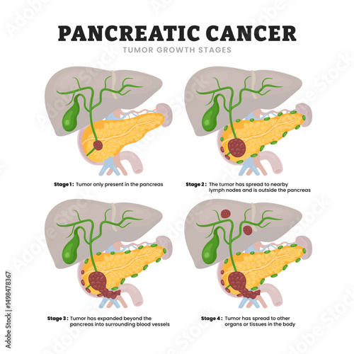 Pancretic Cancer Tumor Growth Stages Development Process, educational medical poster design healthcare scheme, human pancreas disease internal organs. Labeled Tumor spreads pancreas organ tissue.