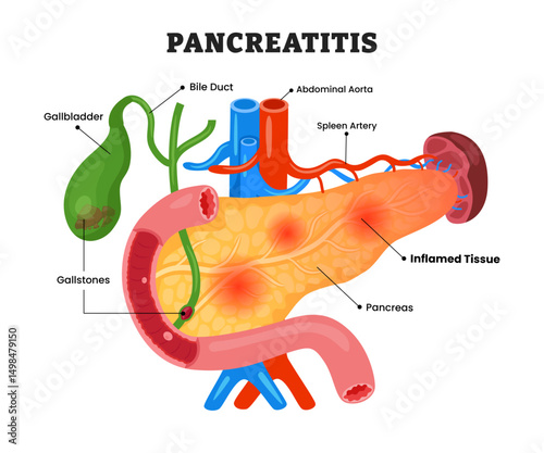 Pancreatitis or Pancreas Inflammation, educational medical poster design healthcare scheme, human pancreas disease internal organs. Labeled gallstones, inflamed tissue, bile duct.