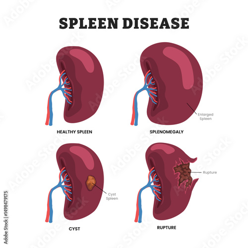 Set of spleen disease set collection, educational medical poster design healthcare scheme, human spleen disease internal organs. Labeled plenic Cyst or Cystic Spleen, Splenic Rupture, Splenomegaly.