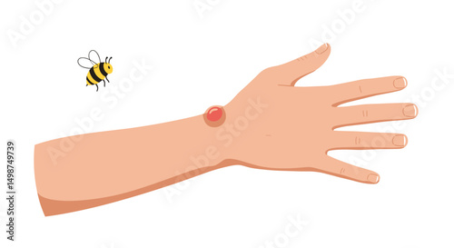 Hand with bee sting on skin and bee flying nearby  