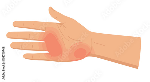 Human hand with pain sensations in palm and fingers illustration  