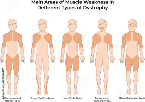 Main Areas of Muscle Weakness in Different Types of Dystrophy