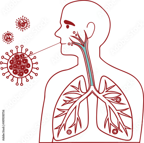Virus Infection Affecting Human Respiratory System – Medical Illustration