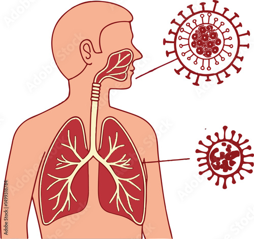 Human Respiratory System and Virus Infection – Medical Anatomy Illustration