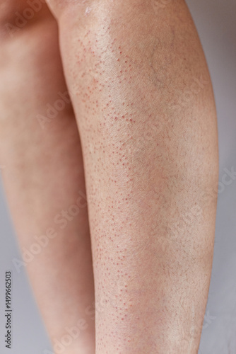 Εκτύπωση καμβά Close-up of female legs showing red rash, irritation and partial hair regrowth after epilation