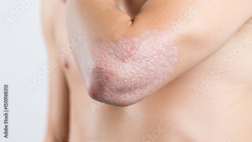 Psoriasis on male elbow with scaly skin patches during chronic flare-up for dermatology reference, autoimmune disease awareness, clinical education, and medical treatment materials