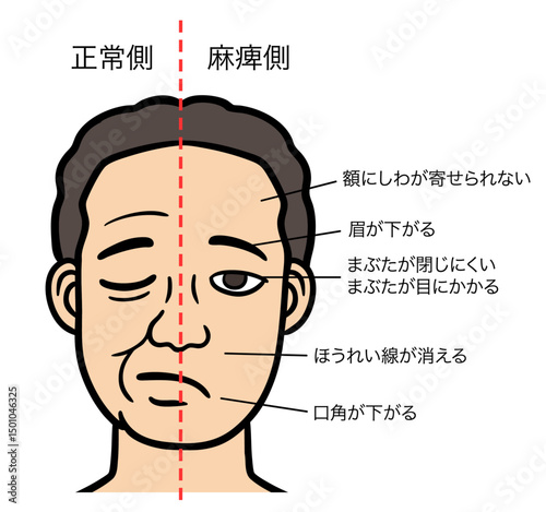 顔面神経麻痺の症状があり目を閉じる男性の顔、正常側と麻痺側の対比