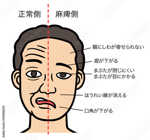 顔面神経麻痺の症状が出ている男性の顔、正常側と麻痺側の対比