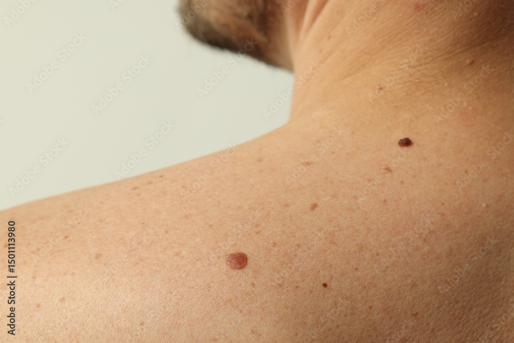 Naklejka premium Man with mole on his skin against light background, closeup