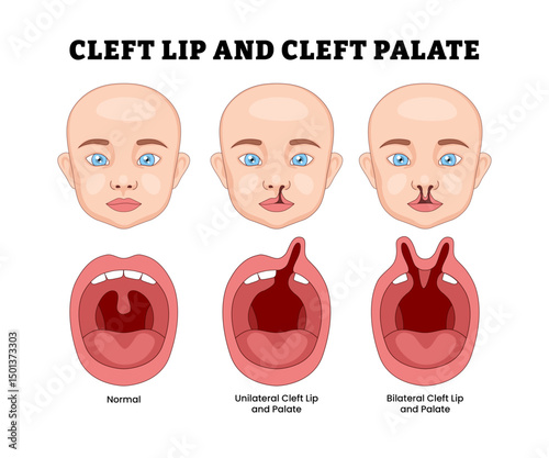 Different types of cleft lip and cleft palate with kids, educational medical poster design healthcare scheme, labeled Bilateral, Unilateral and normal, birth defect newborn, opening or gap lip.