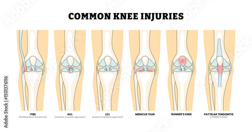 Different types of common knee injury types, educational medical poster design healthcare scheme, labeled ACL, Anterior, Cruciate, Ligament, Knee, Injury, ITBS, Iliotibial, Band, Syndrome, LCL.