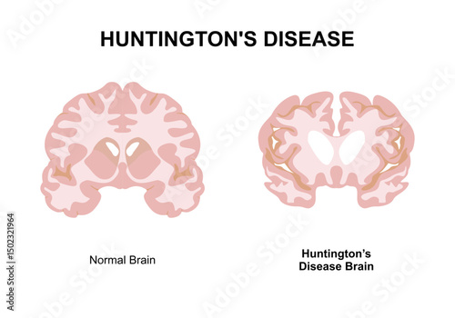Huntington's disease brain disorder illustration