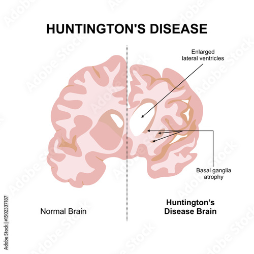 Huntington's disease Illustration Brain disorder