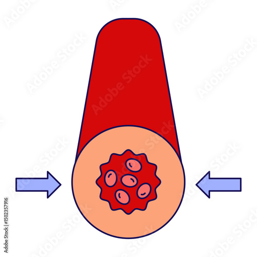 vasoconstriction