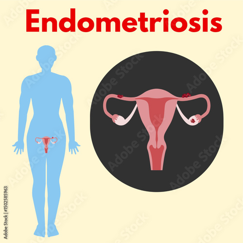 endometriosis zoom in from body uterus disease woman reproductive disease illustration useful for healthcare industry.eps