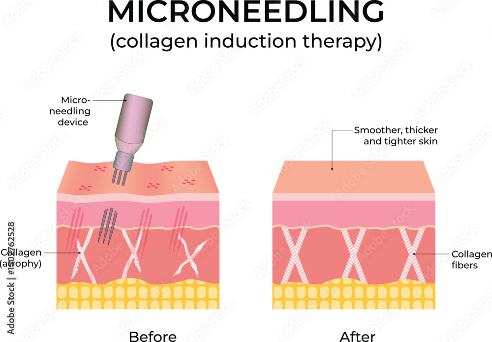 Microneedling Collagen Induction Therapy Diagram Design Vector Illustration