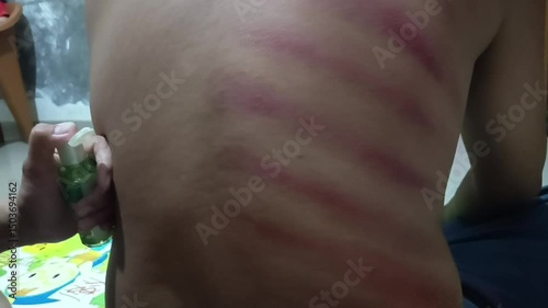 Scraping is a traditional healing method to eliminate all diseases that stick to the sufferer's body.