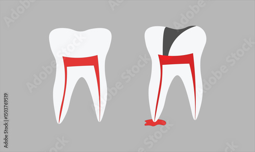 Dental healthy and infected teeth vector illustration