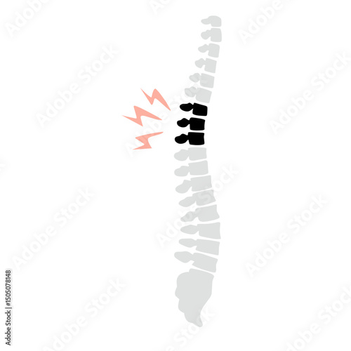 Spinal fracture vector illustration