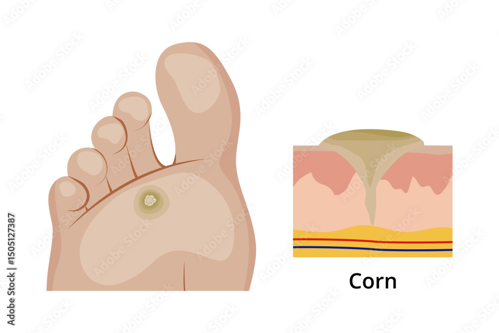 Corn on the sole of the foot and its anatomical structure