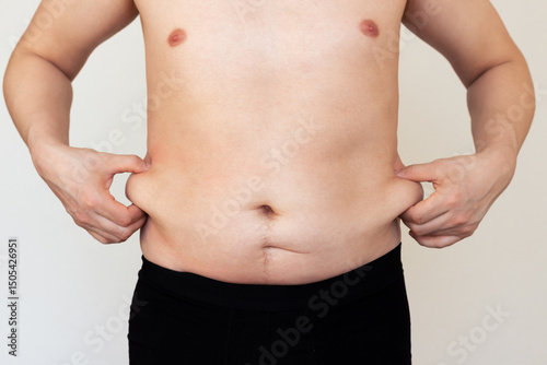 An adult Caucasian man showing fat folds on the sides of his waist with his hands after losing weight. Obesity, overweight.