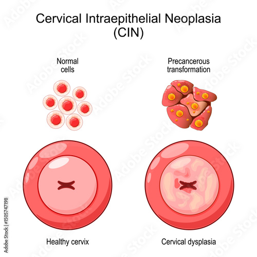 Cervical dysplasia. CIN. Process of cancer development