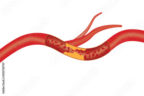 Atherosclerosis in artery with plaque buildup, blood vessel disease medical illustration. eps 10