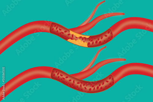 Illustration of clogged and healthy artery showing blood flow and plaque buildup comparison. eps 10