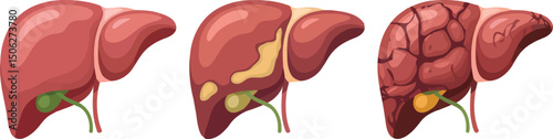 depicts the stages of liver disease progression over time. Starting from a healthy state, it illustrates the changes leading to fatty liver and then cirrhosis. 