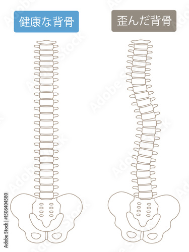 歪んだ背骨と健康な背骨