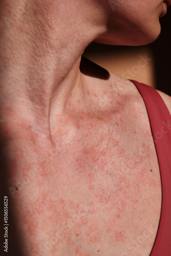 Close-up of woman skin affected by psoriasis. Eczema, rash and other skin diseases. Autoimmune genetic disease. Imperfect beauty.