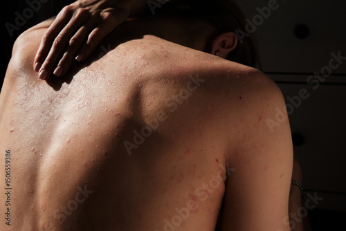 Close-up of woman touching her back, spine, skin affected by psoriasis. Eczema, rash and other skin diseases. Autoimmune genetic disease. Imperfect beauty.