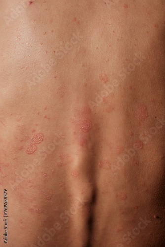 Close-up of woman skin affected by psoriasis. Eczema, rash and other skin diseases. Autoimmune genetic disease. Imperfect beauty.