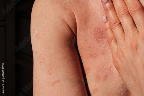 Close-up of woman touching her back, spine, skin affected by psoriasis. Eczema, rash and other skin diseases. Autoimmune genetic disease. Imperfect beauty.