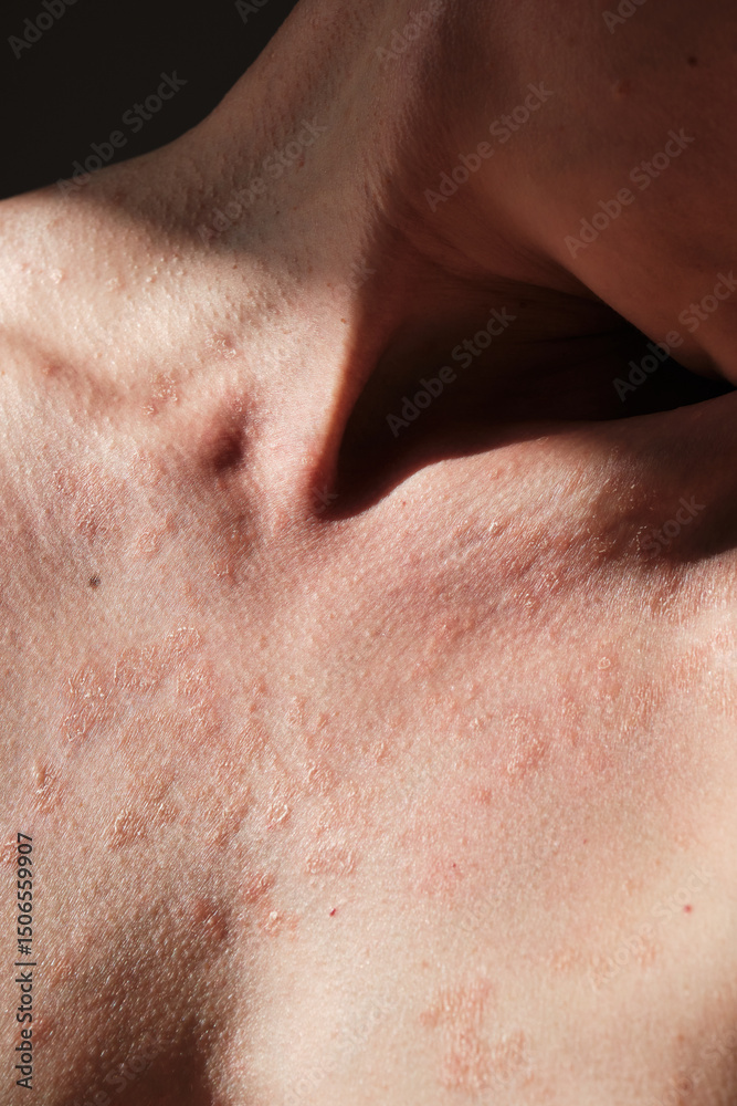 Naklejka premium Close-up of skin affected by psoriasis. Eczema, rash and other skin diseases. Autoimmune genetic disease. Imperfect beauty.