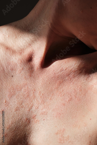 Close-up of skin affected by psoriasis. Eczema, rash and other skin diseases. Autoimmune genetic disease. Imperfect beauty.