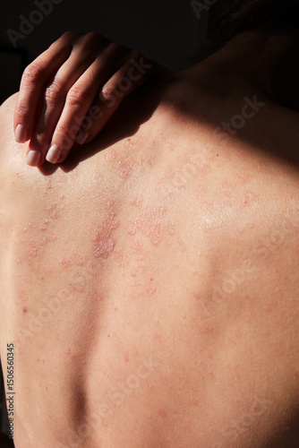 Close-up of woman touching her back, spine, skin affected by psoriasis. Eczema, rash and other skin diseases. Autoimmune genetic disease. Imperfect beauty.