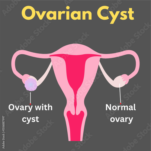 ovarian cyst   uterus disease woman reproductive disease illustration useful for healthcare industry.eps