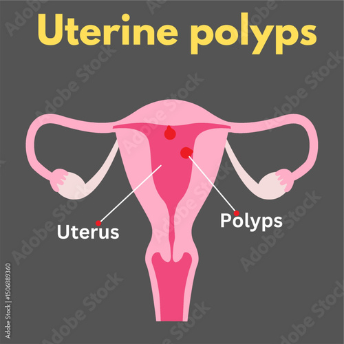 uterine polyps uterus disease woman reproductive disease illustration useful for healthcare industry.eps