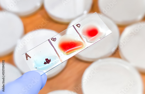 Blood group and Rh factor testing by slide agglutination method. Blood typing. A Negative (A-) blood group, a rare type of blood group.
