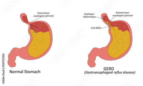 Gastroesophageal reflux disease(GERD) vector illustration