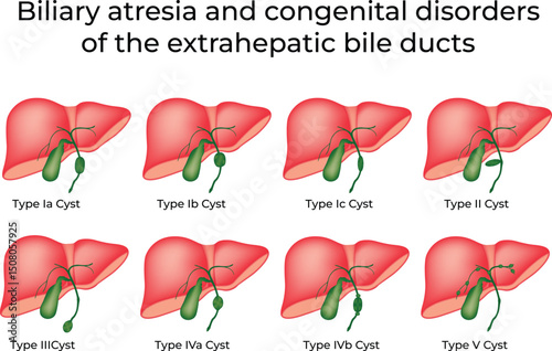 Biliary Atresia and Congenital Disorders of Bile Ducts