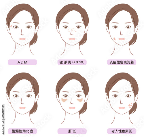 顔にできたシミの種類　美容　女性